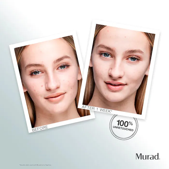 Murad Outsmart Acne Clarifying Treatment